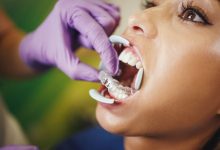 top-5-reasons-to-get-invisalign-in-palos-verdes-instead-of-braces